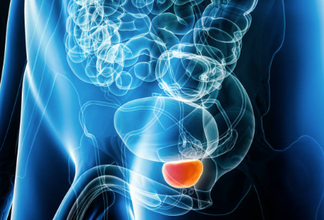 Benign Prostatic Hyperplasia