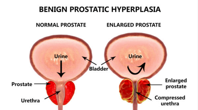 BPH Urology Treatment