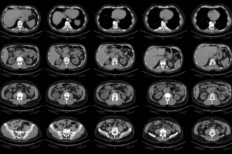 Acute Prostate Inflammation Symptoms